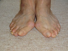 外反母趾について 足の痛み お悩み専門 靴と足gait