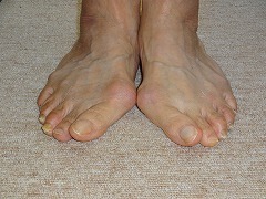 外反母趾について 足の痛み お悩み専門 靴と足gait 外反母趾について 足の痛み お悩み専門 靴と足gait
